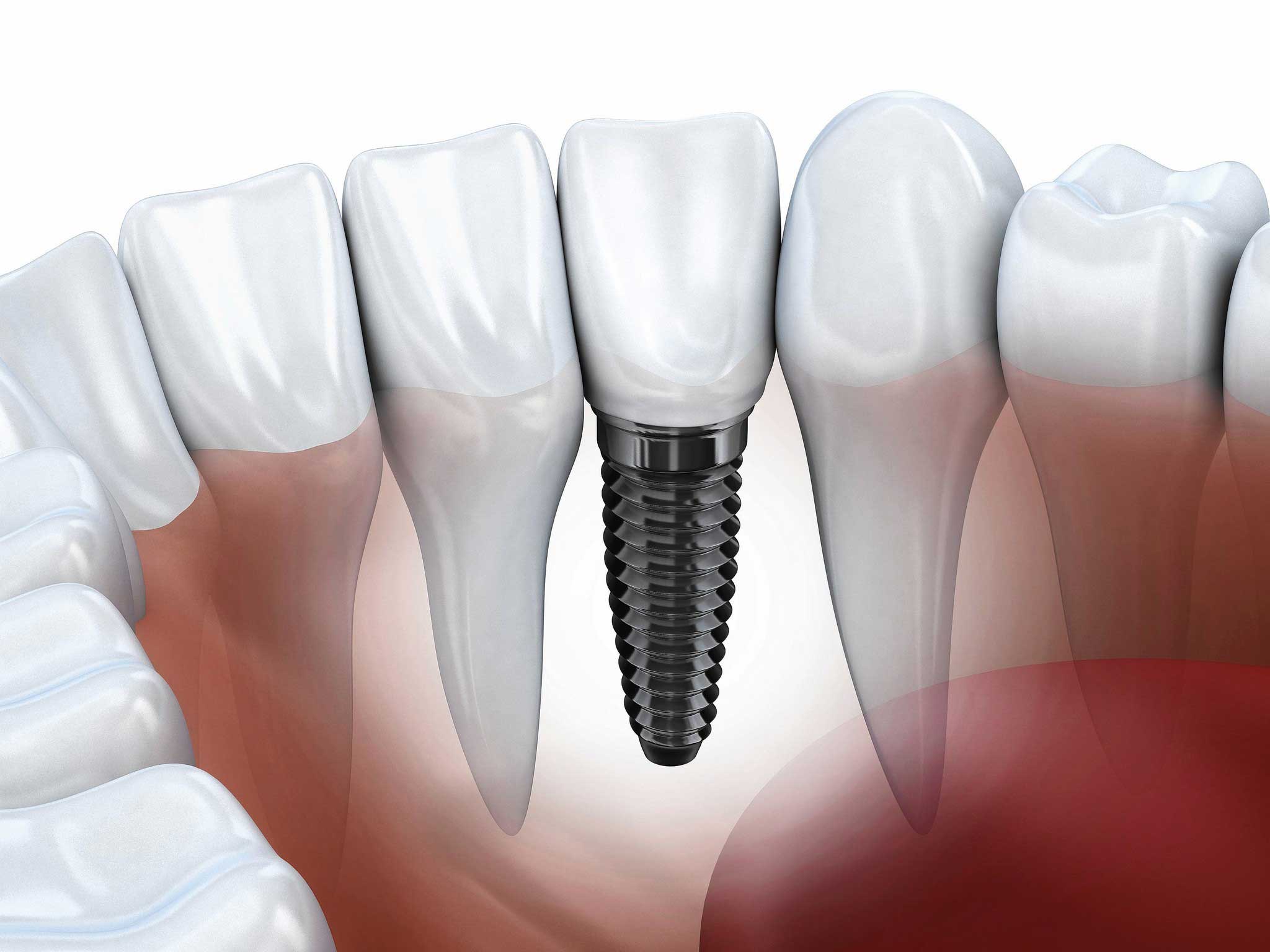 Dental-implants-1024x768@2x1